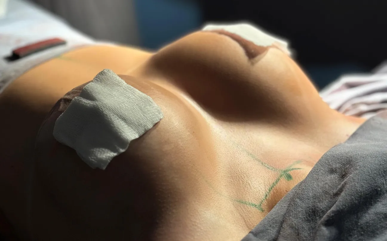 Mamas no pós-operatório imediato de mastopexia com prótese, com curativos nas aréolas e marcações cirúrgicas na pele