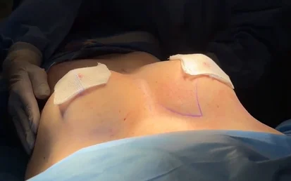 Paciente em centro cirúrgico com marcações de incisão nas mamas e curativos sobre as aréolas, durante o preparo da mastopexia com lipoenxertia